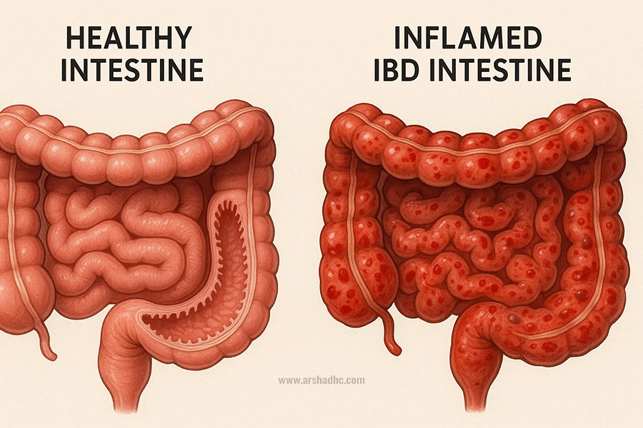Comparison of healthy intestine vs inflamed IBD intestine