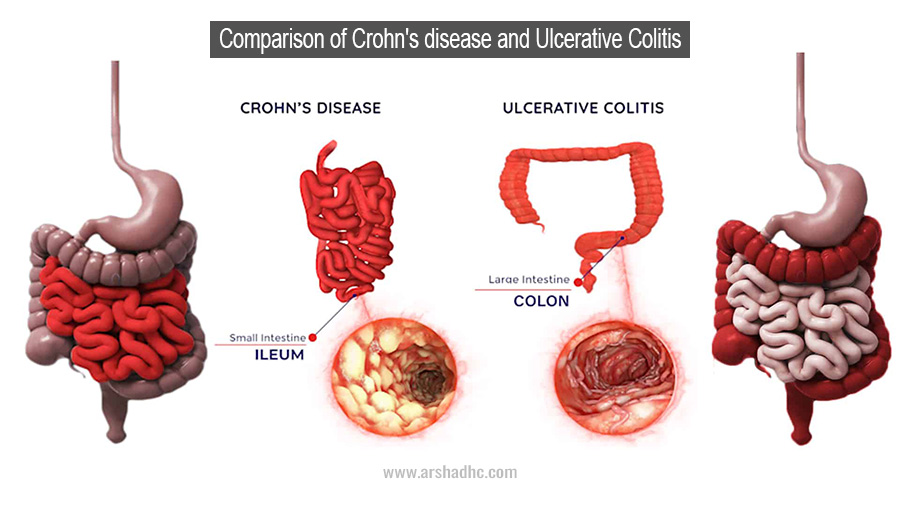 Comparison of Crohn's disease and Ulcerative Colitis