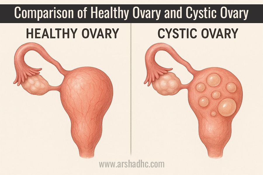 Diagram showing normal ovary vs ovary with cyst