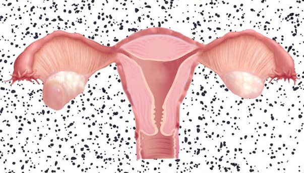 Ovarian Cyst