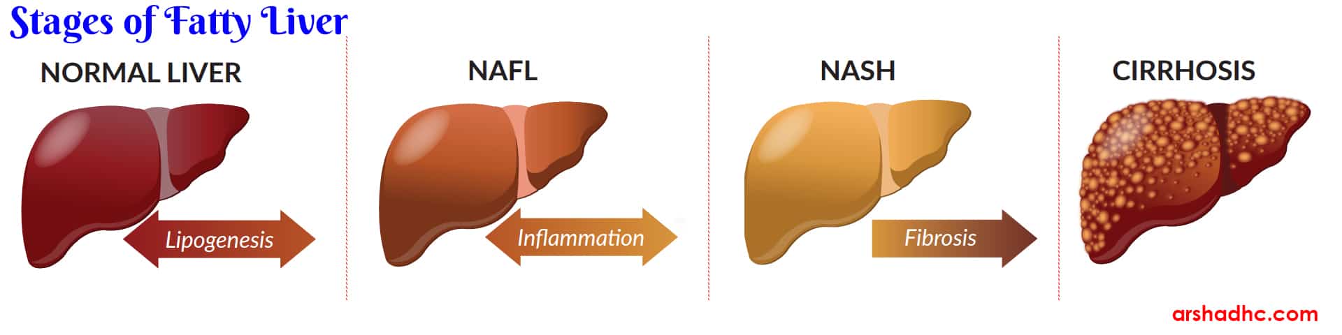 fatty liver stages