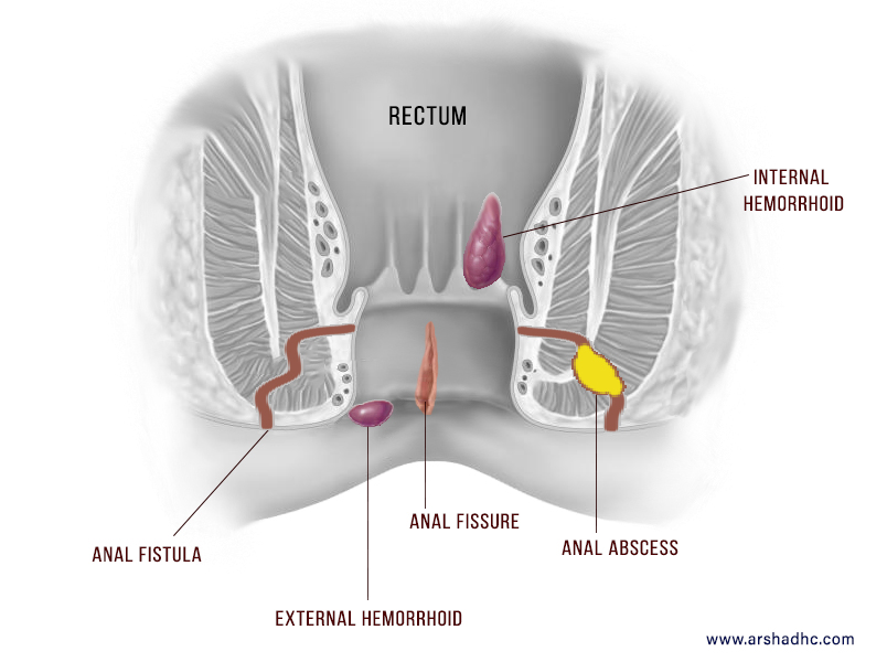 HEMORRHOIDS