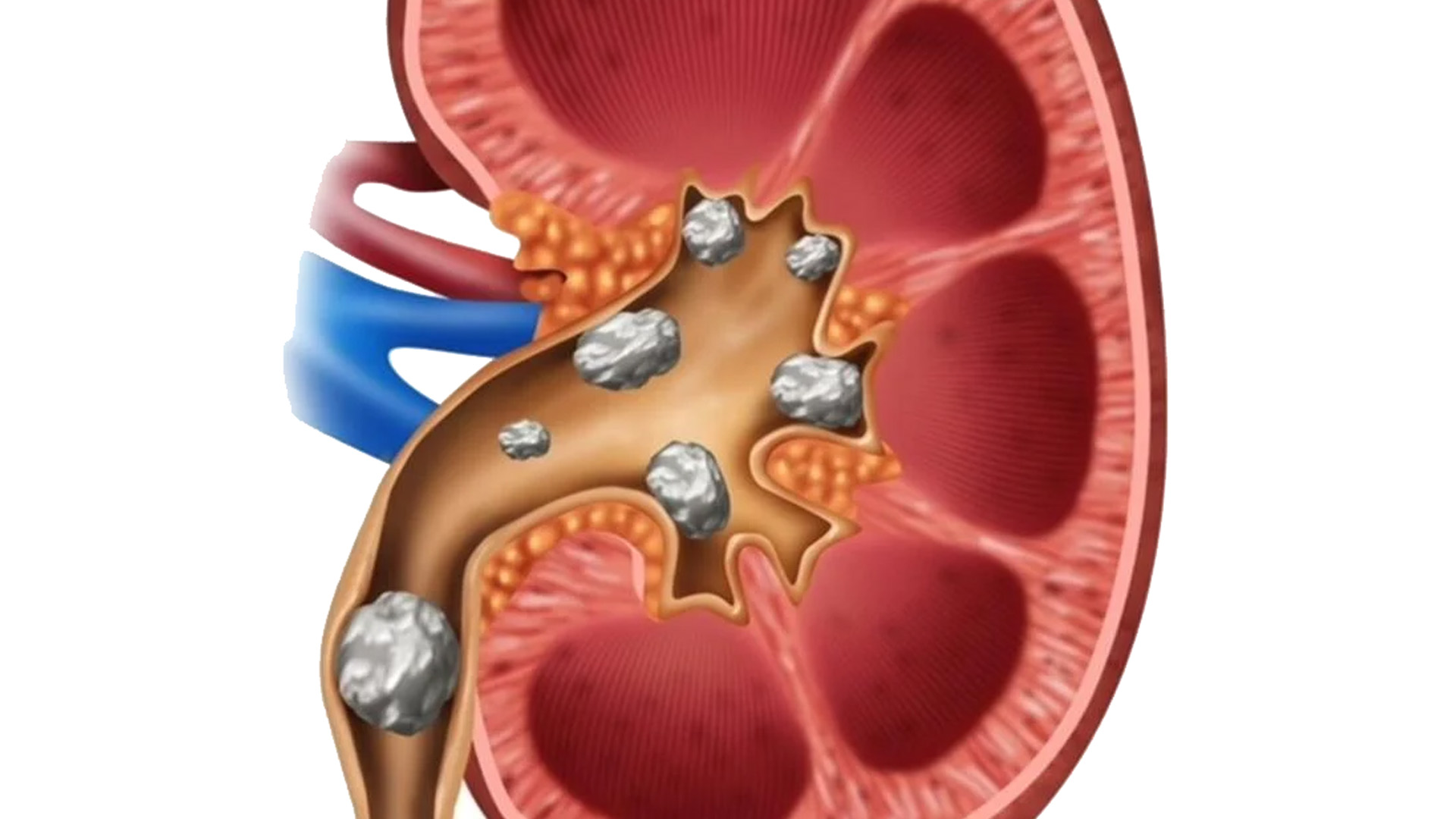 Kidney Stone