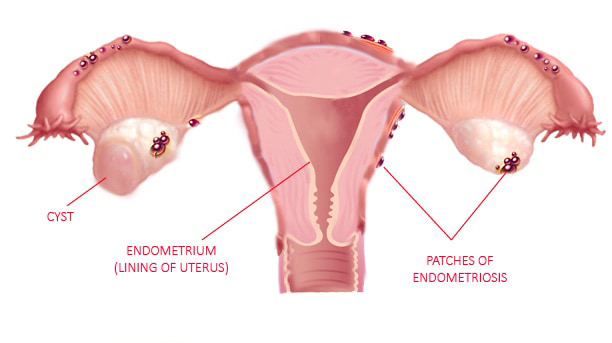 Ovarian Cyst Types