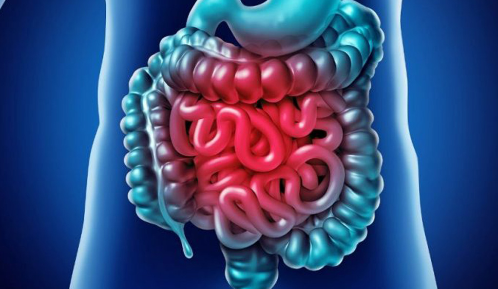 IBD